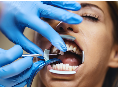 拔牙后的注意事項(xiàng)和飲食禁忌