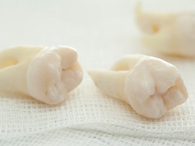 智齒疼了，這牙非拔不可嗎？