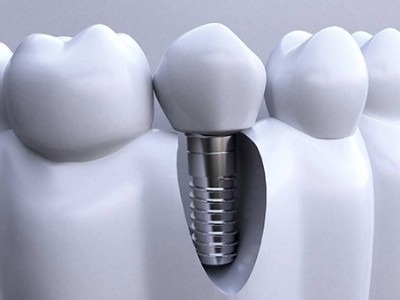 做種植牙全程需要多長時間呢?