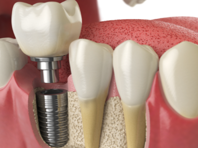 選擇種植牙后要做哪些日常維護？