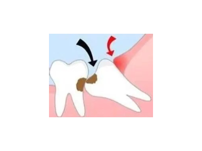 吃完飯后老塞牙？別大意！這可能是你的牙齒在報警