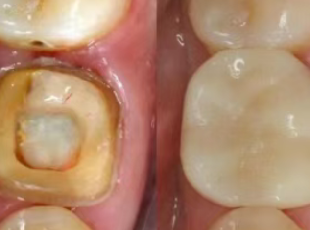 根管治療（抽神經(jīng)）后，為什么一定要做牙冠？