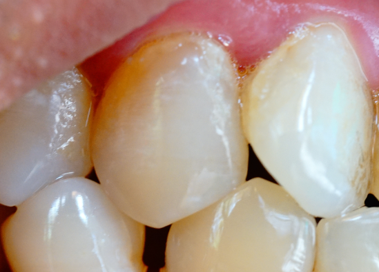 牙齒表面的牙釉質掉了還可以修復嗎？