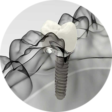 術(shù)前研究、模擬提升種植成功率