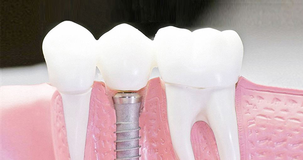 在承德口腔種植牙齒需要多少錢？惟德口腔一一為您道來